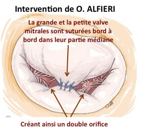 suture_Alfieri.jpg