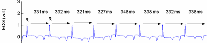 ECG graphe.png